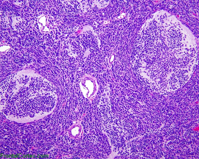 Desmoplastic medulloblastoma, H&E stain x100